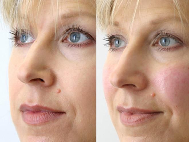 миндальный пилинг миндальный пилинг