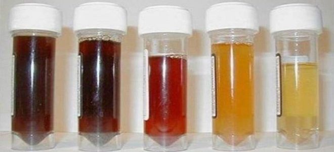 моча при цистите моча при цистите