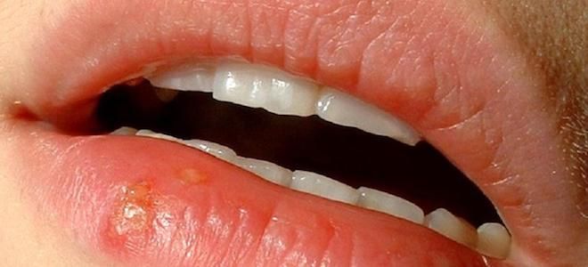 оксолин от герпеса оксолин от герпеса