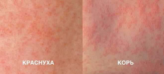 отличие краснухи от кори отличие краснухи от кори