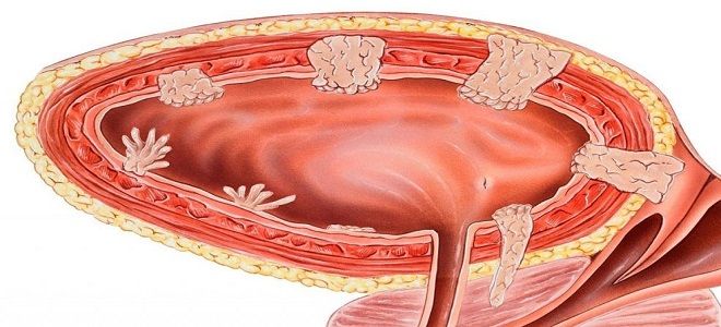 полипы в мочевом пузыре полипы в мочевом пузыре