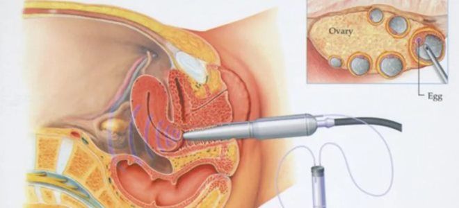 пункция ооцитов пункция ооцитов