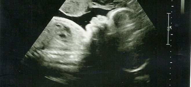 роды в 33 недели роды в 33 недели