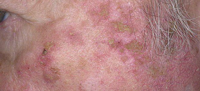 Солнечная кератома Солнечная кератома