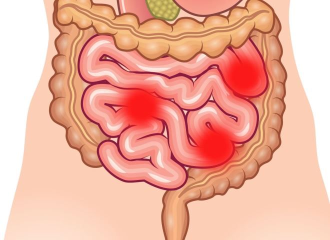 воспаление тонкого кишечника воспаление тонкого кишечника
