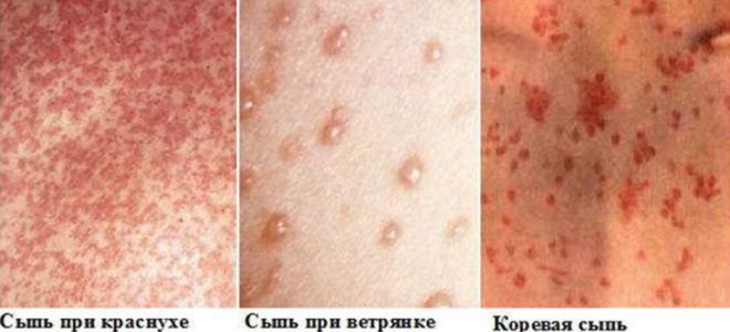 чем отличается краснуха от ветрянки чем отличается краснуха от ветрянки