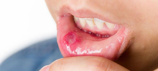 оксолин при стоматите оксолин при стоматите