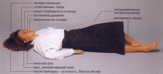 приступ эпилепсии приступ эпилепсии