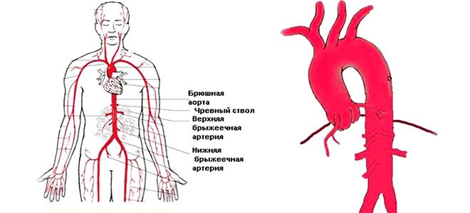 признаки атеросклероза аорты признаки атеросклероза аорты