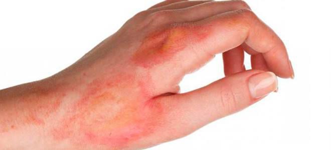 солкосерил от ожогов солкосерил от ожогов