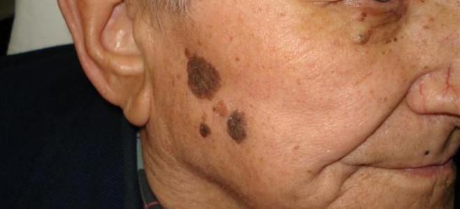 Старческая кератома Старческая кератома