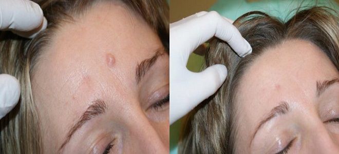 удаление родинок папиллом удаление родинок папиллом