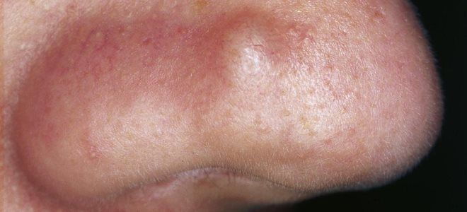 виды твердого шанкра виды твердого шанкра