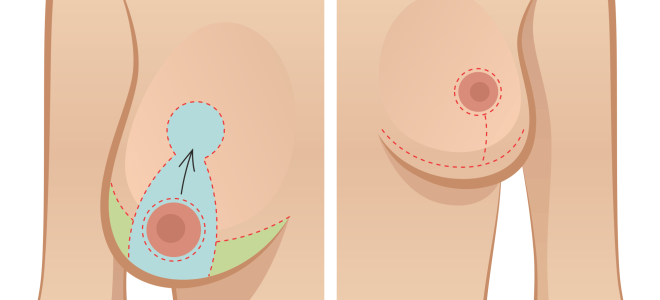 Якорная мастопексия Якорная мастопексия