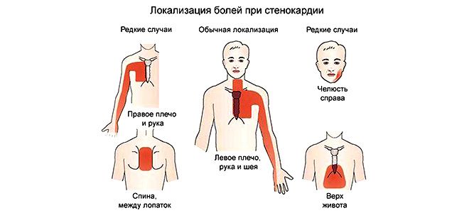 атеросклероз восходящей аорты атеросклероз восходящей аорты