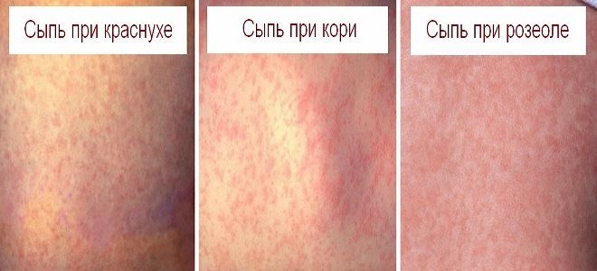 чем отличается краснуха от розеолы чем отличается краснуха от розеолы