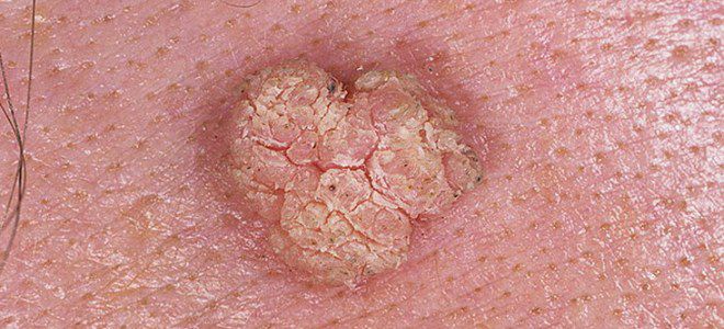 Фолликулярная кератома Фолликулярная кератома