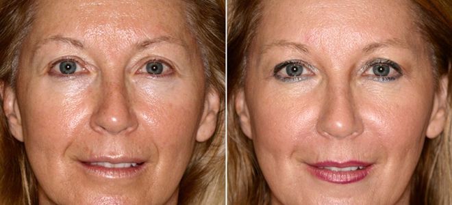 коктейли для мезотерапии коктейли для мезотерапии