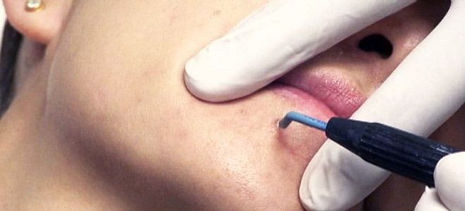 место удаления родинки место удаления родинки