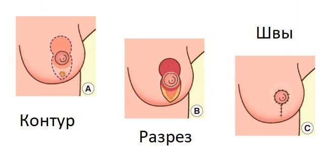 Вертикальная мастопексия Вертикальная мастопексия