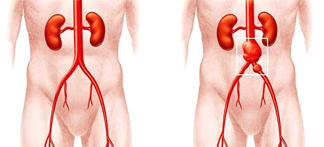 атеросклероз брюшной аорты атеросклероз брюшной аорты