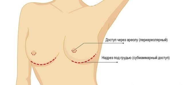 Дермальная мастопексия Дермальная мастопексия