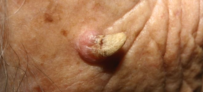 Кожный рог Кожный рог