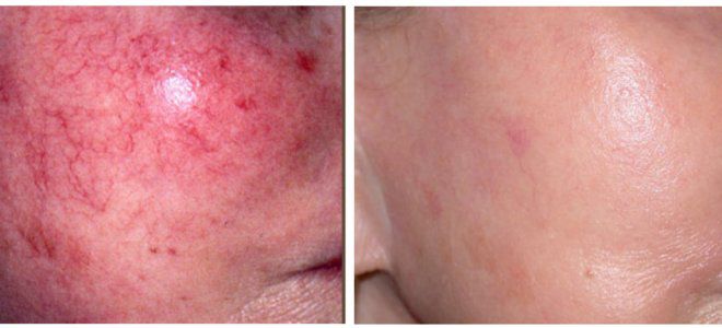 Лечение розацеа лазером Лечение розацеа лазером