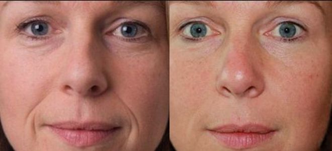мезотерапия лица фото до и после мезотерапия лица фото до и после