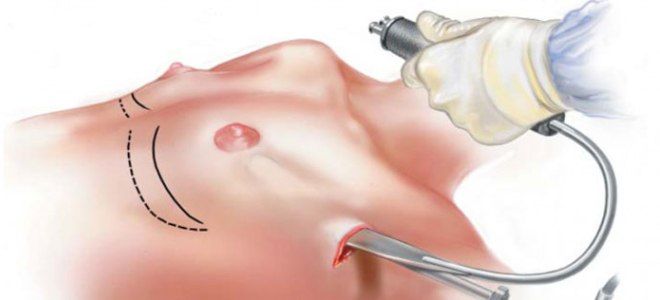 Эндоскопическая мастопексия Эндоскопическая мастопексия